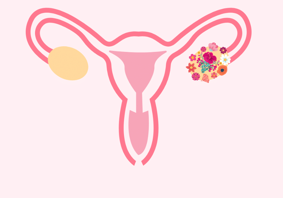 syndrome des ovaires polykystiques : comprendre la pathologie
