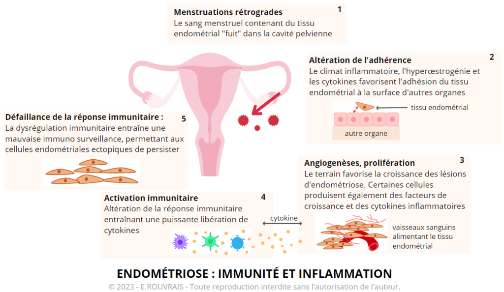 Endométriose - inflammation et immunité