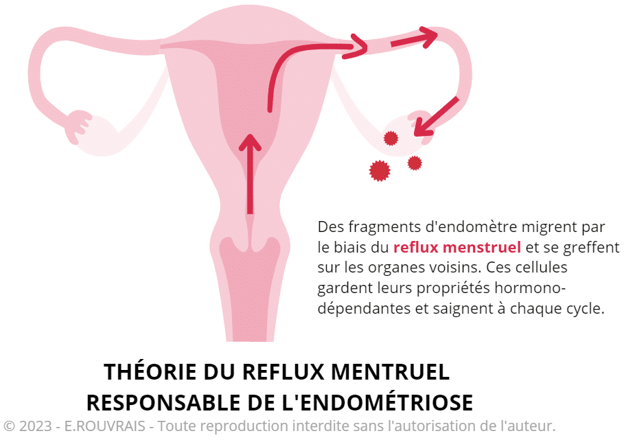 Théorie du reflux menstruel responsable de l'endométriose